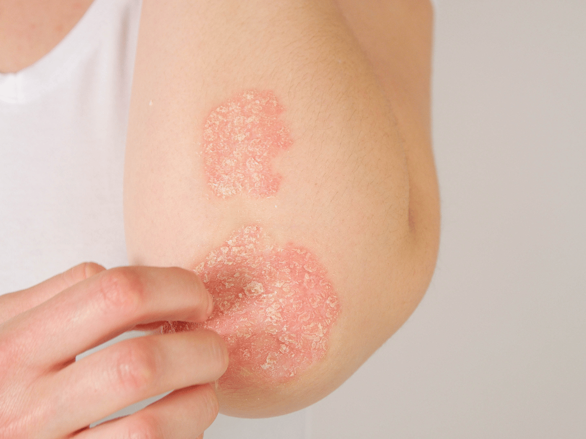 psoriasis treatment needs