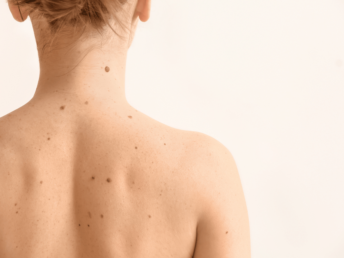 girl with moles on her back