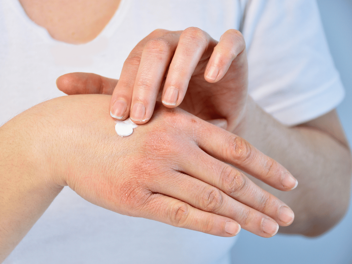 eczema on hands